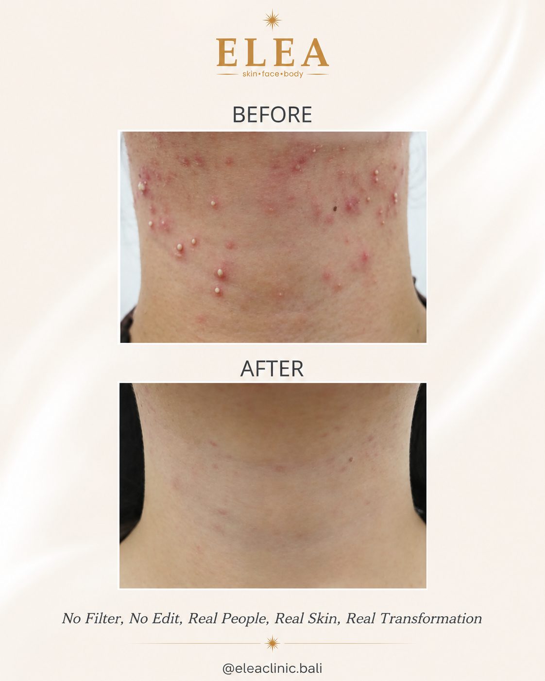 Acne treatment before and after — body — Elea Clinic Bali