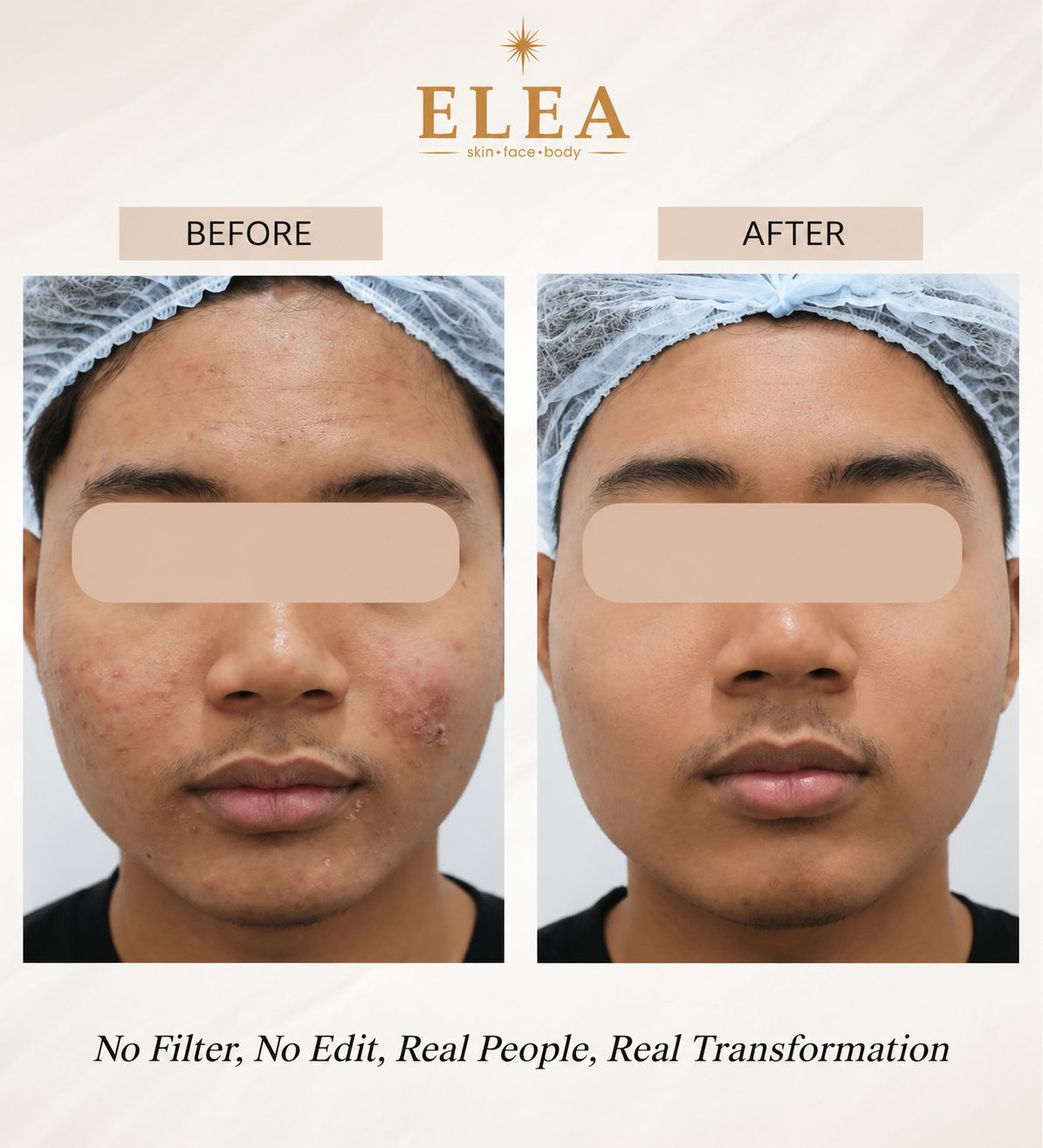 Acne treatment before and after result at Elea Clinic Bali