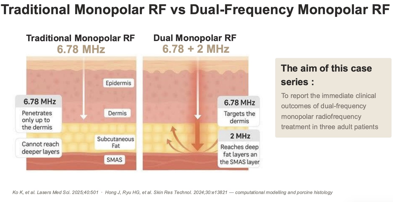 Presentation slide comparing traditional monopolar radiofrequency at 6.78 MHz with dual-frequency delivery at 6.78 and 2 MHz