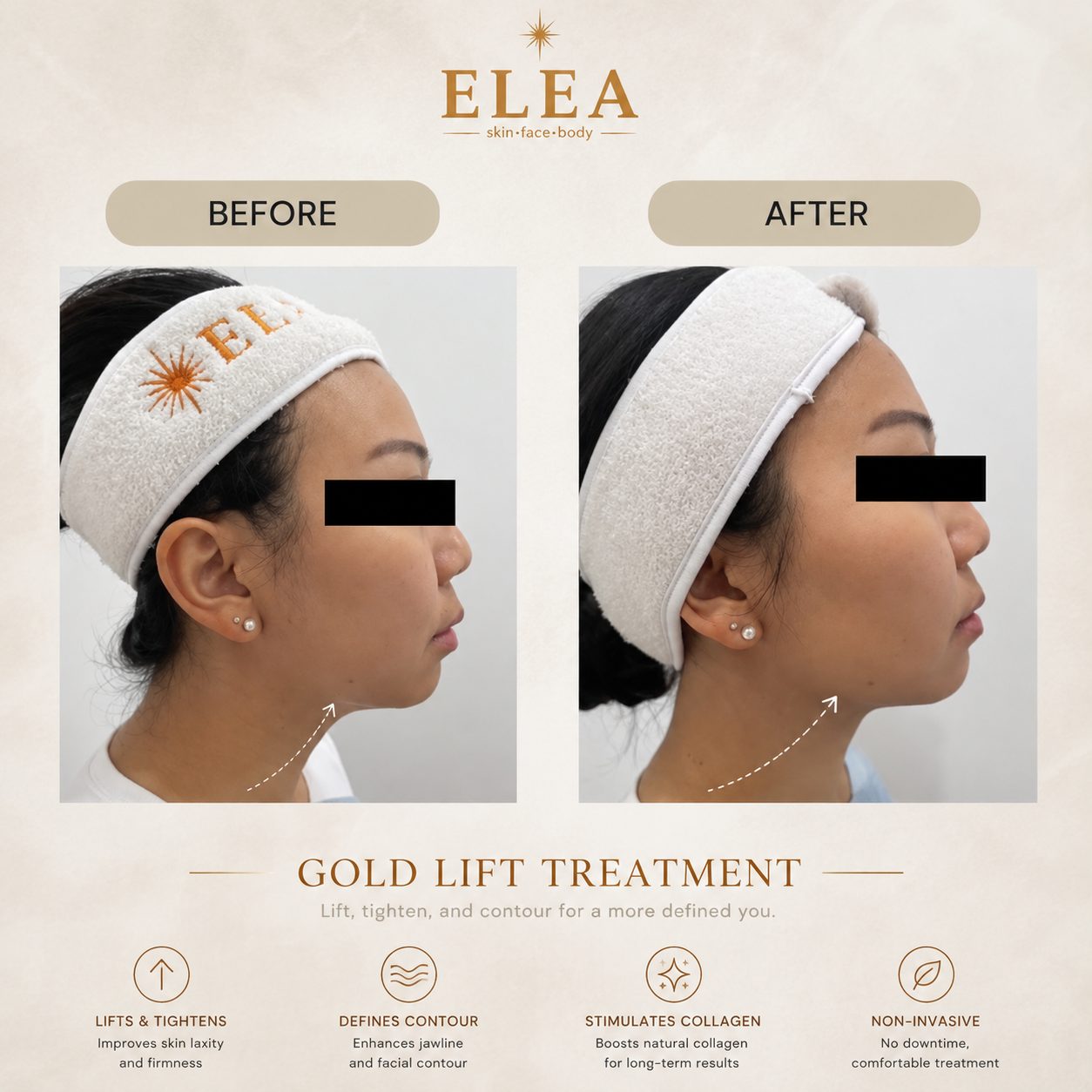 Gold Lift Before and After — Elea Clinic Bali