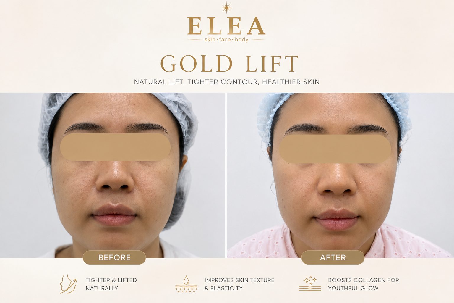 Non-surgical facelift before and after result at Elea Clinic Bali