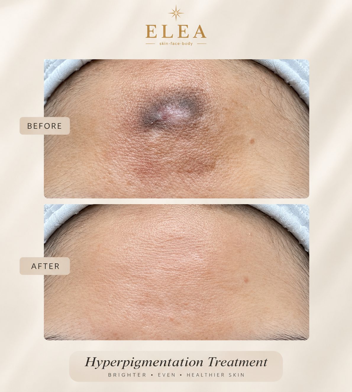 Hyperpigmentation before and after result at Elea Clinic Bali