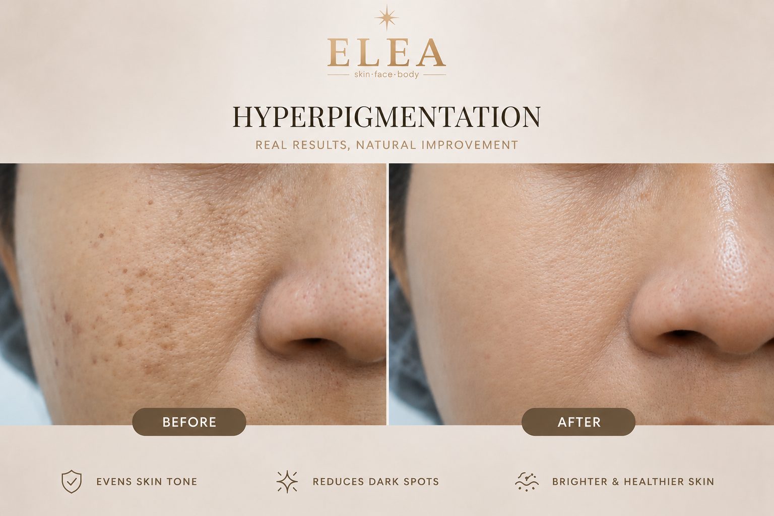 Hyperpigmentation before and after result at Elea Clinic Bali