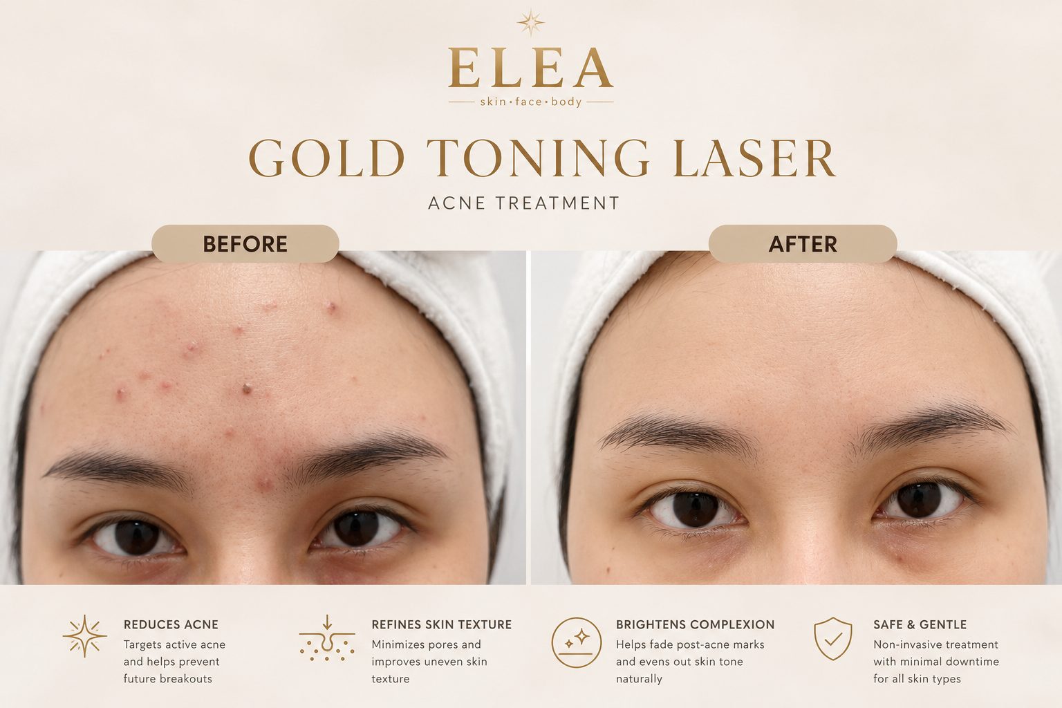 Gold Toning Laser acne treatment before and after at Elea Clinic Bali