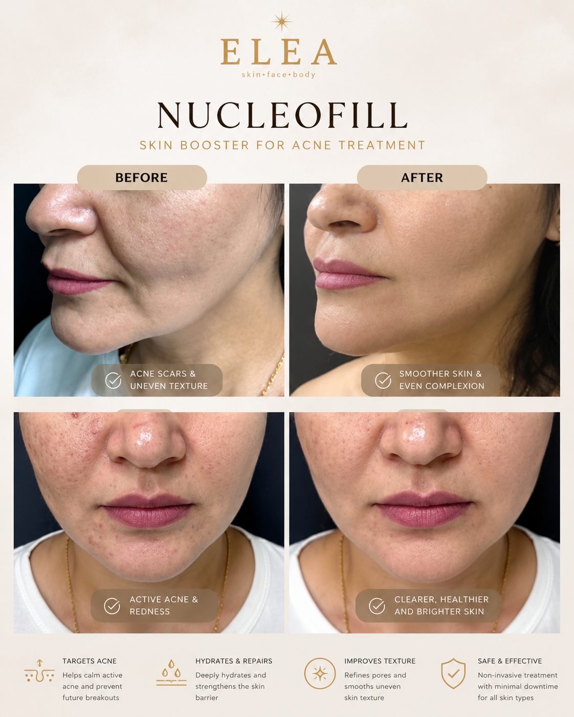 Nucleofill skin booster acne and texture improvement at Elea Clinic Bali