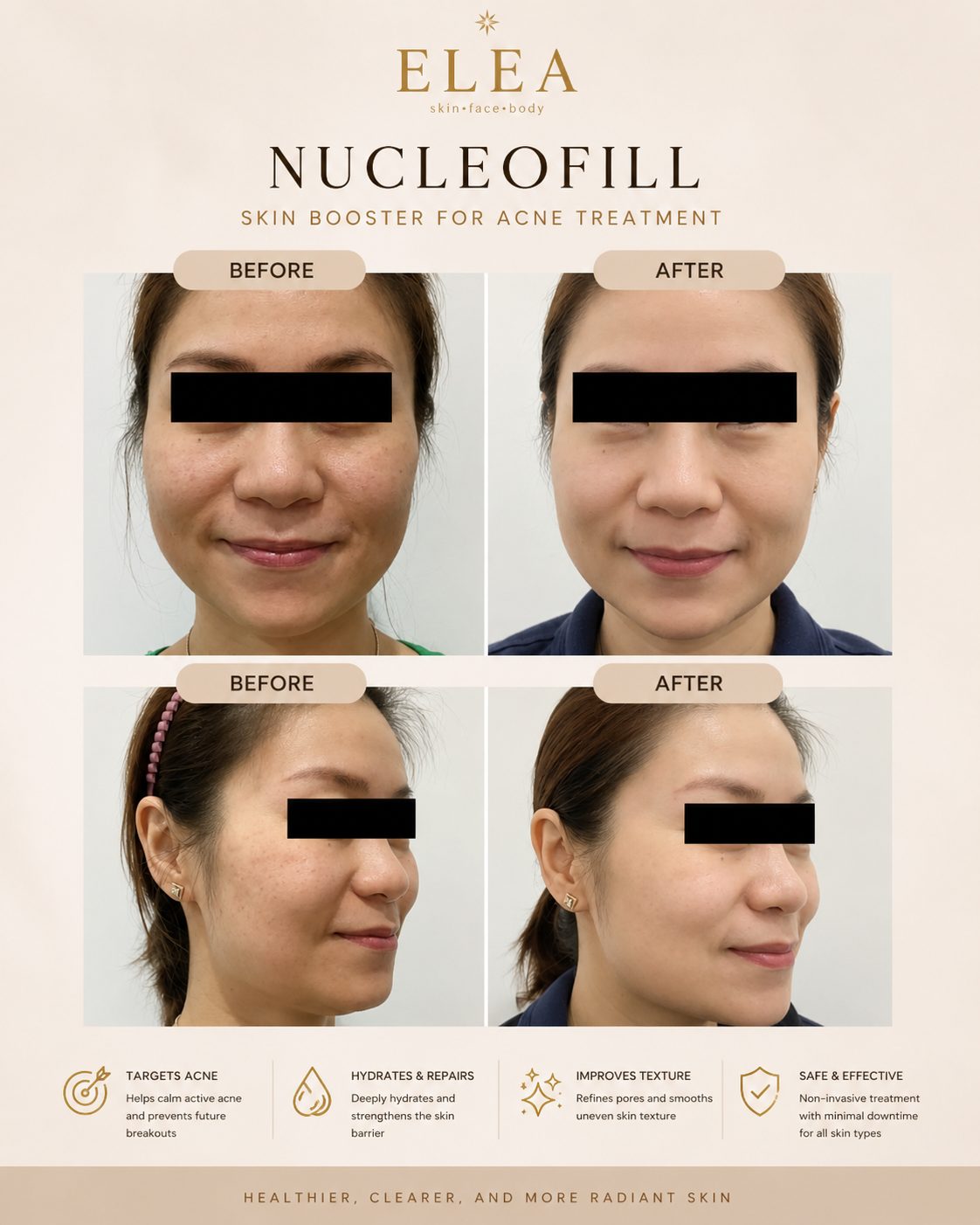 Nucleofill acne treatment before and after — Elea Clinic Bali