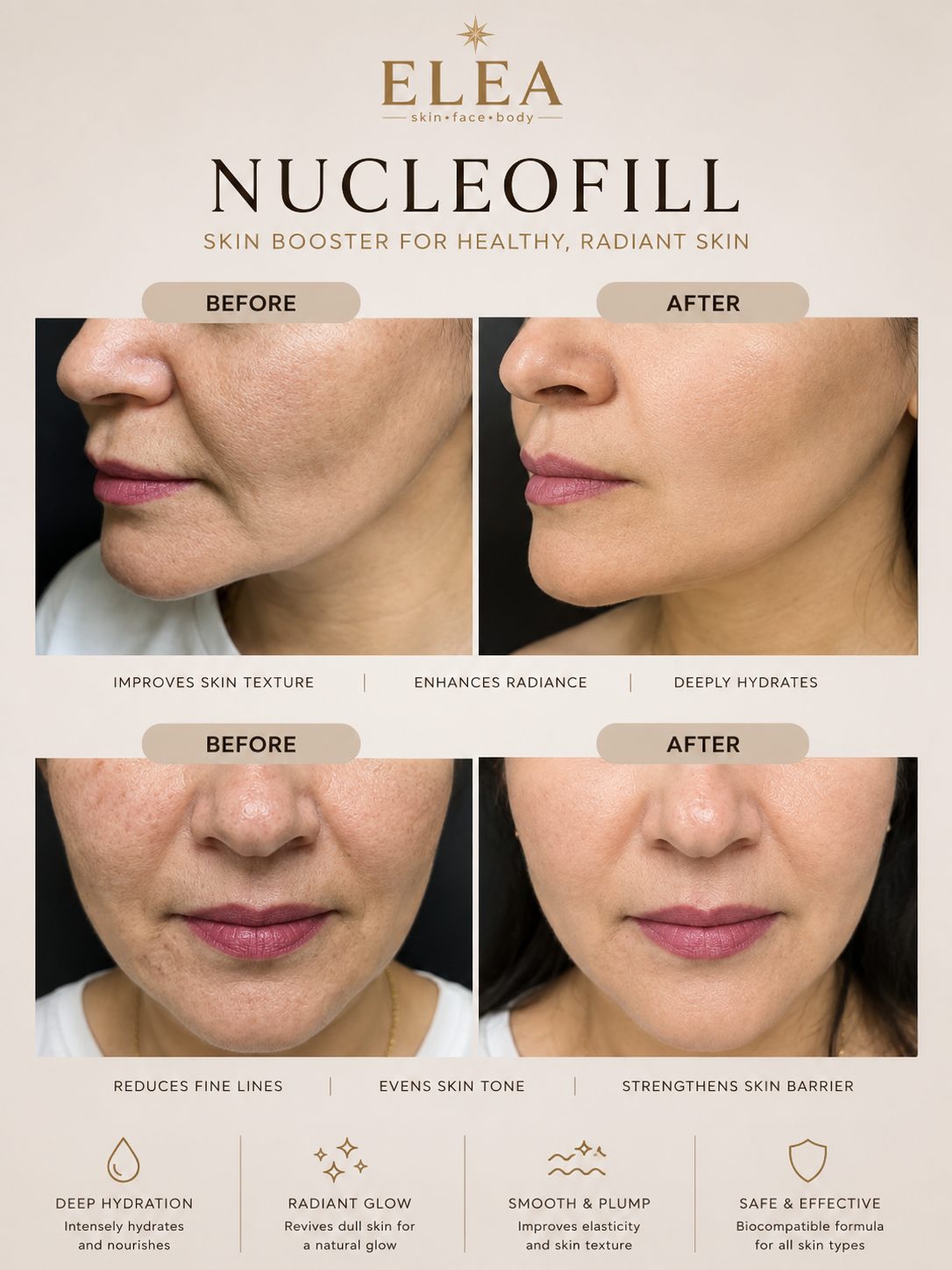 Nucleofill skin quality before and after — Elea Clinic Bali