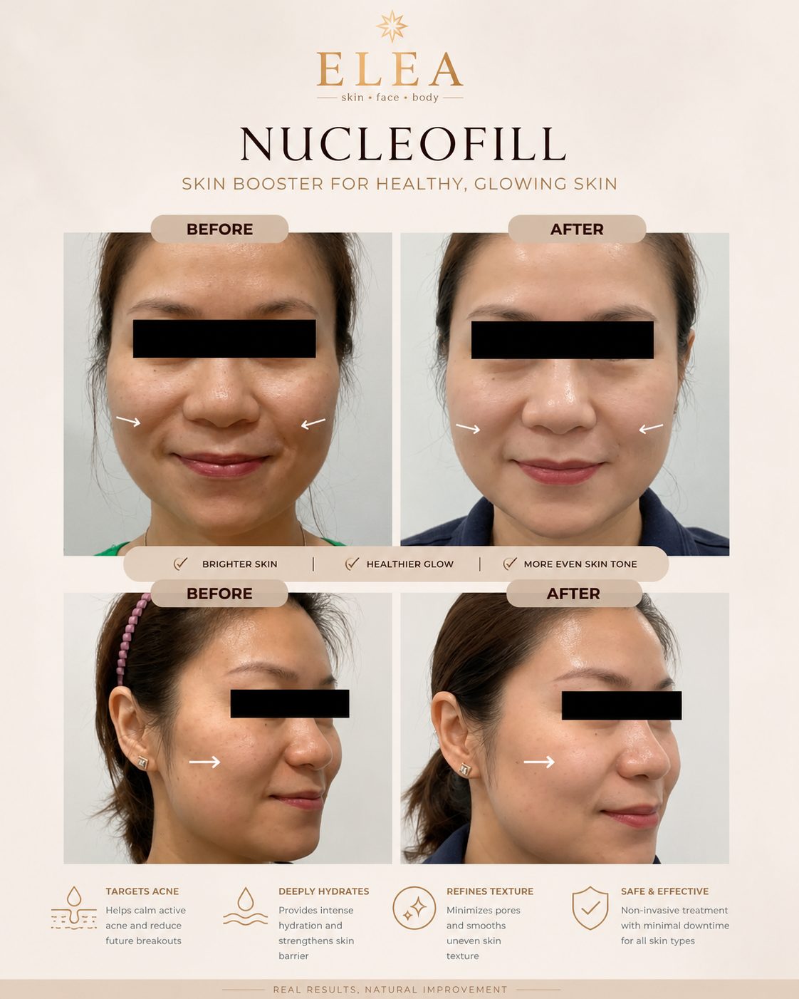 Nucleofill skin booster before and after result at Elea Clinic Bali