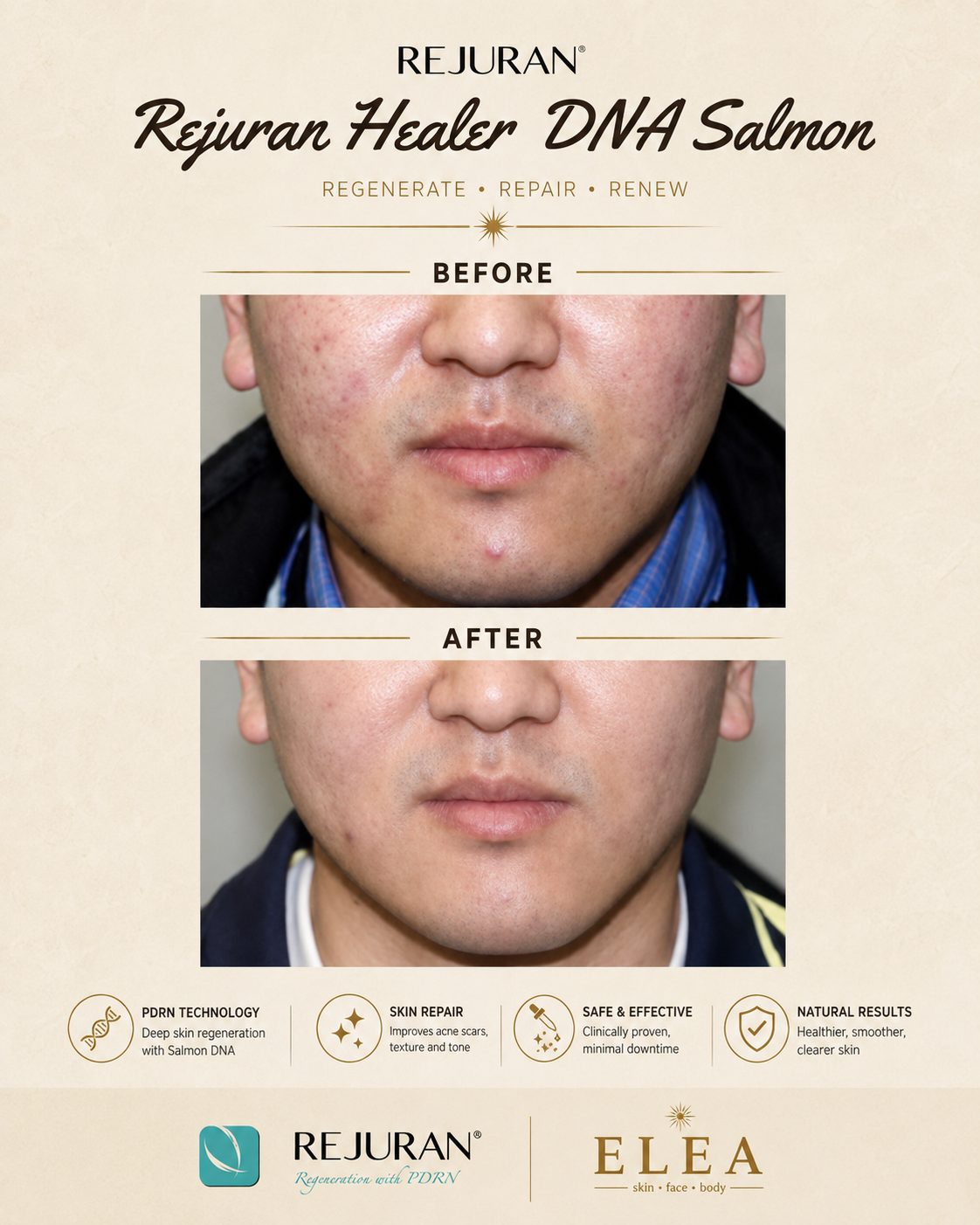 Rejuran Healer before and after result at Elea Clinic Bali