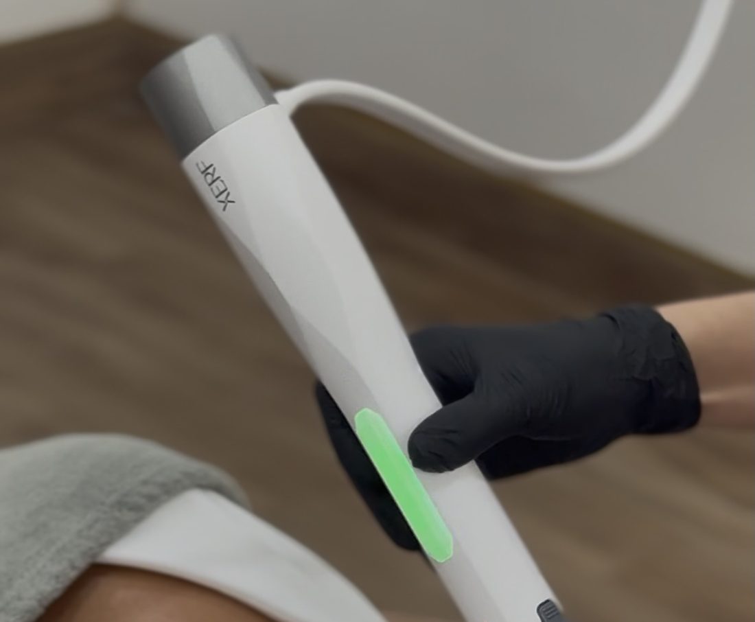 XERF treatment tip and cooled handpiece in use at Elea Clinic Bali